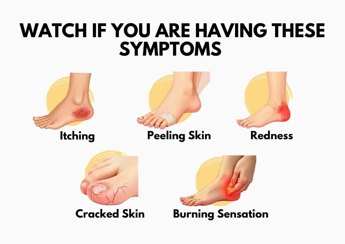 Infographic showing symptoms related to Sweaty Feet, including itching, peeling skin, redness, cracked skin, and burning sensation on the feet.