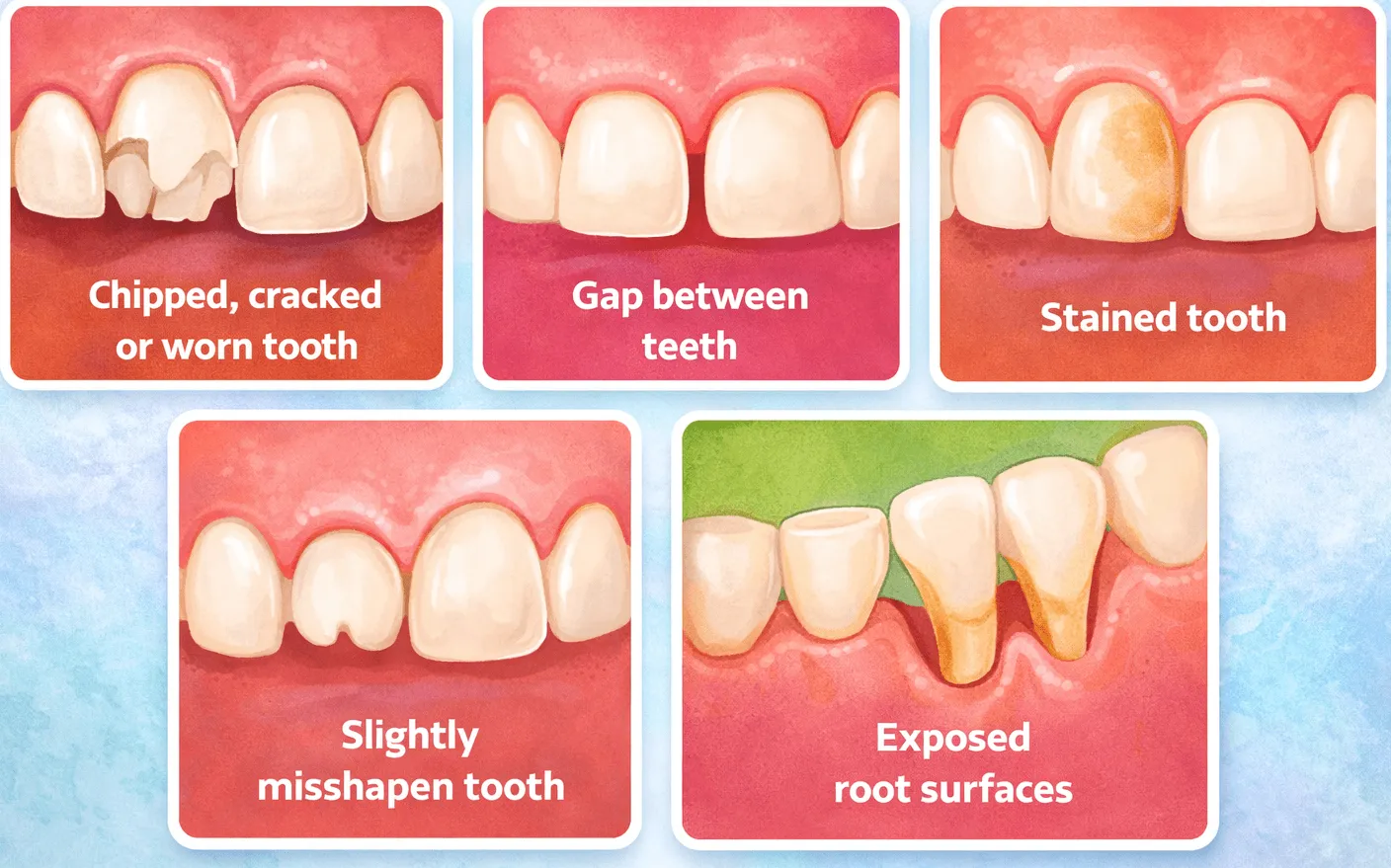 Illustration showing common dental issues treated with cosmetic dental bonding including chipped tooth, gap between teeth, stained tooth, misshapen tooth, and exposed root surfaces