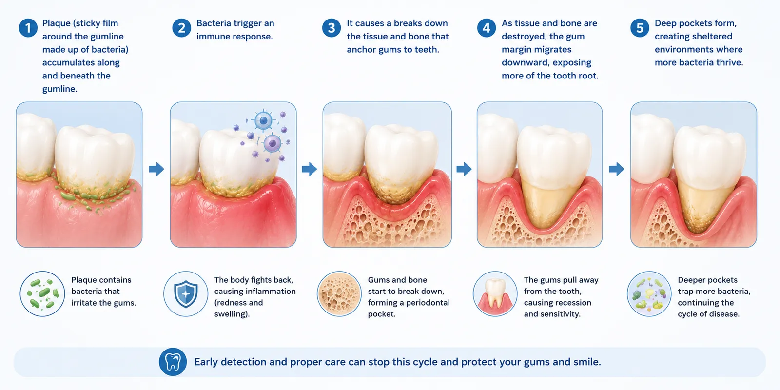 Gum Disease vs Gum Recession infographic showing the progression from plaque buildup and bacterial infection to inflammation