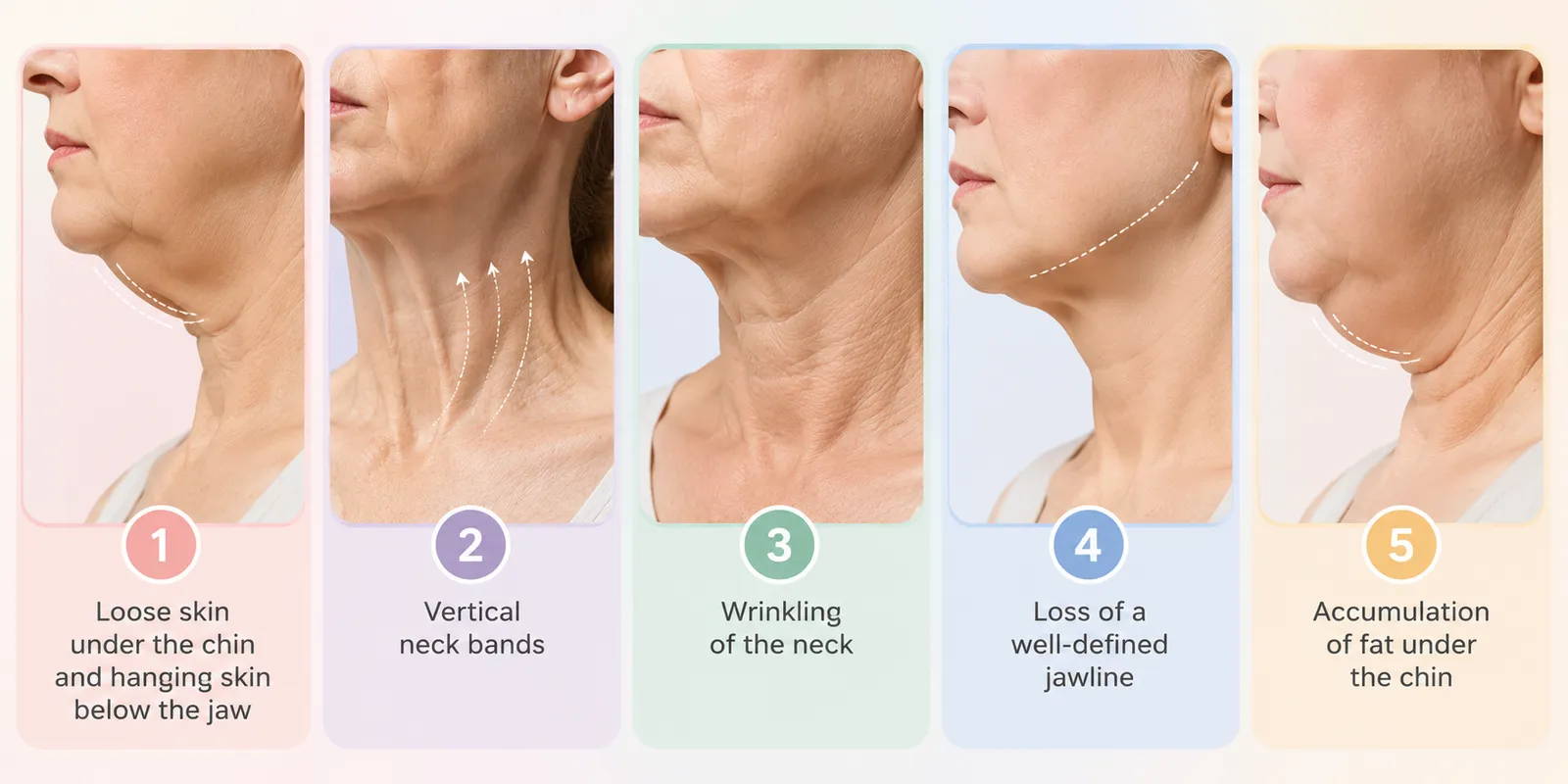 Turkey Neck characterized by loose skin under the chin, vertical neck bands, neck wrinkling, loss of a well-defined jawline, and fat accumulation under the chin.